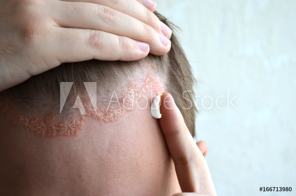 Scalp Psoriasis