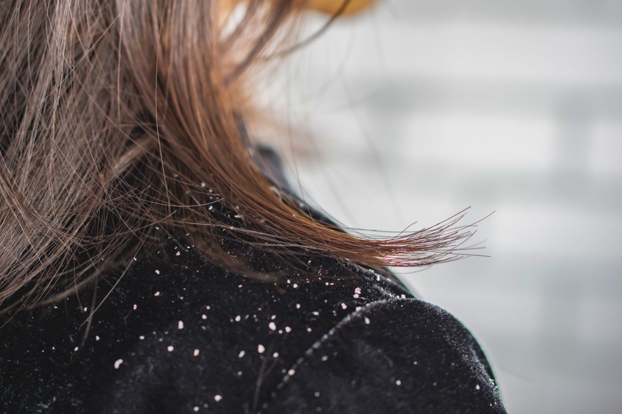 Dandruff - How to treat