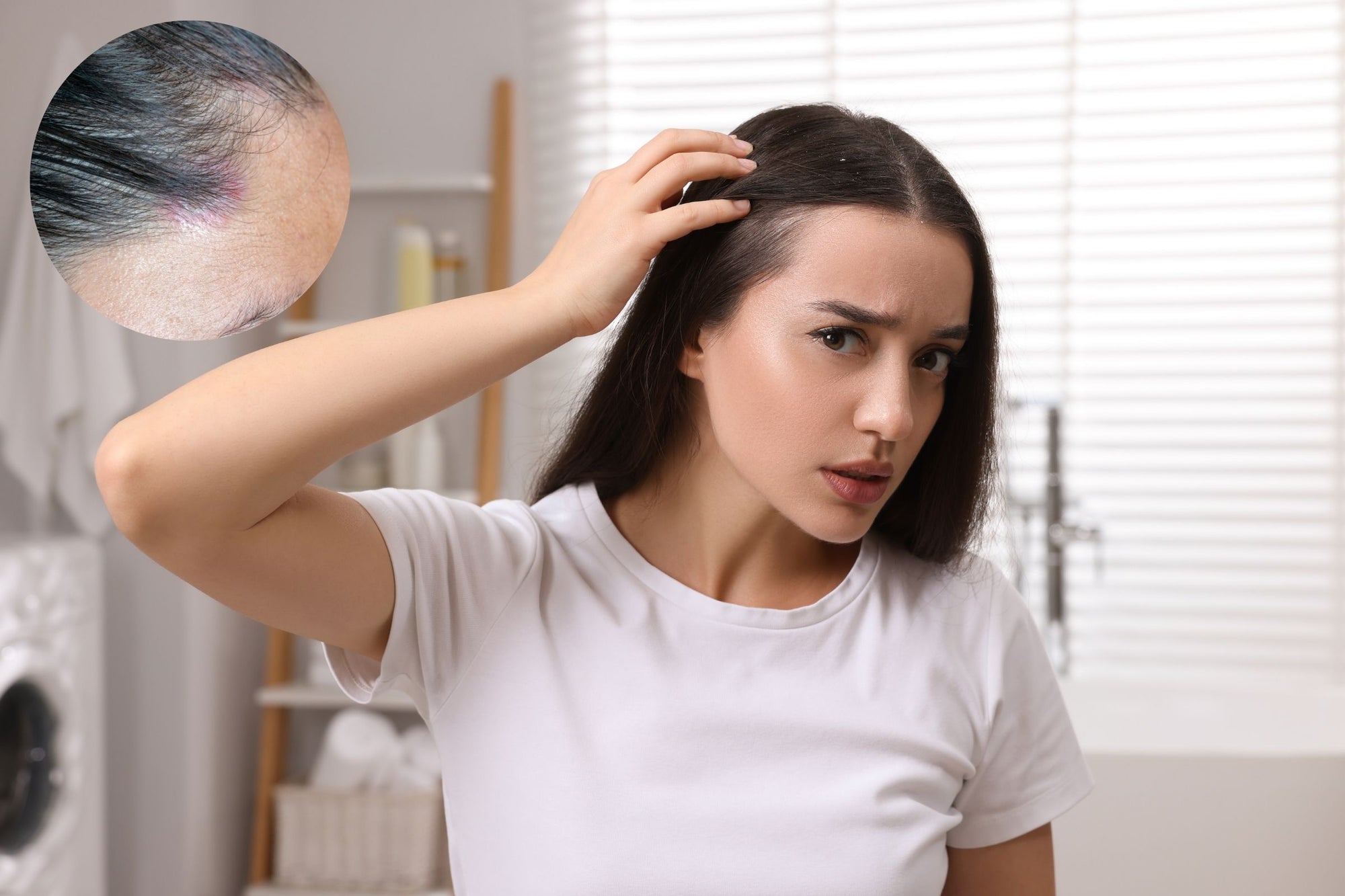 Scalp Psoriasis
